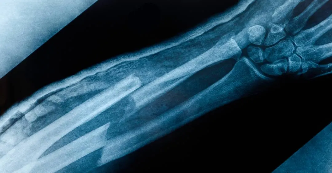 Cientistas testam “pistola de cola quente” para reparar ossos quebrados