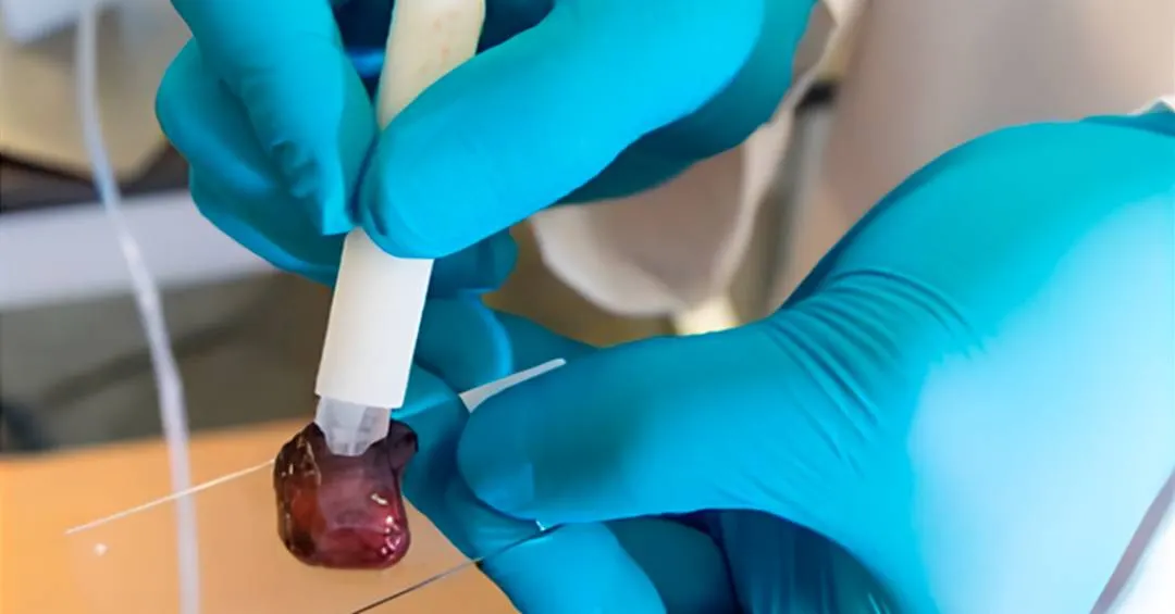 Caneta que detecta câncer em tempo real durante cirurgia chega ao Brasil