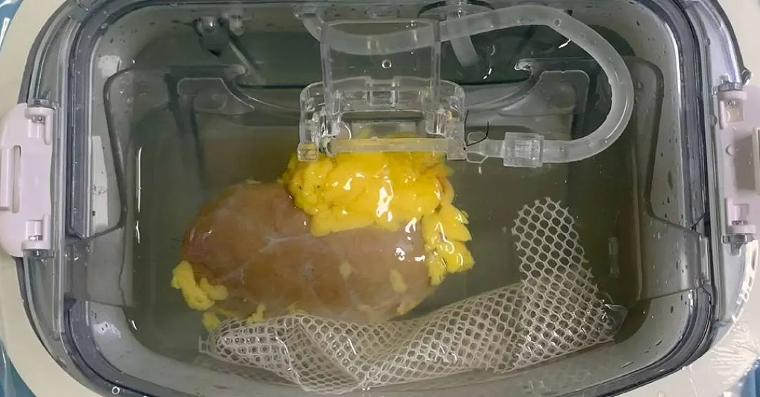 Pela primeira vez, médicos transplantam rim com tipo sanguíneo modificado